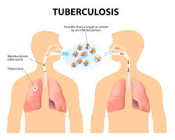 WHO announces updates on new molecular assays for the diagnosis of tuberculosis (TB) and drug resistance