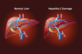 WHO highlights progress in accelerating access to hepatitis C diagnostics and treatment in low- and middle-income countries