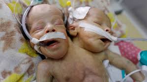 UNICEF airlifts Yemeni conjoined twins to Jordan for specialized medical care