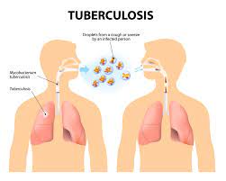 Development of updated WHO guidelines on the management of tuberculosis in children and adolescents