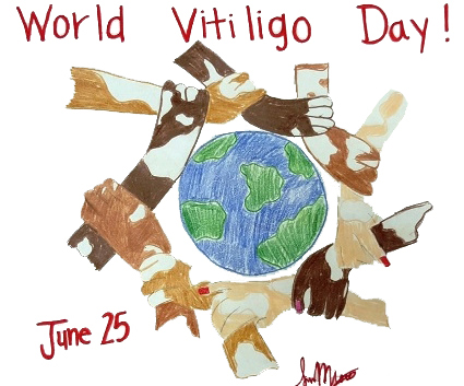 World Vitiligo Day 2021