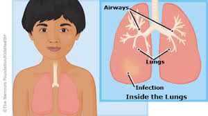 New Policy on Pneumonia to Reduce Infant Mortality