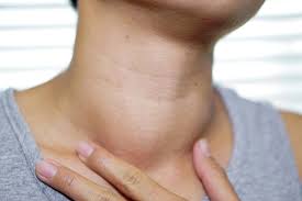 Status of Goitre or Thyroid Disorders in India