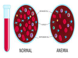 CONTROL OF ANAEMIA AMONG CHILDREN IN THE COUNTRY