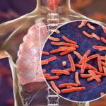 Under-Representation of Children and Teens in Drug-Resistant Tuberculosis Cases Raises Concerns, Studies Show