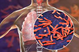 EMA Recommends New Diagnostic Tool for Tuberculosis Detection