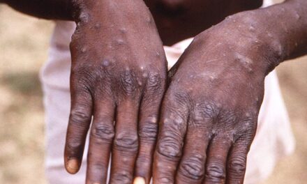 Monkeypox: public health advice for gay, bisexual and other men who have sex with men