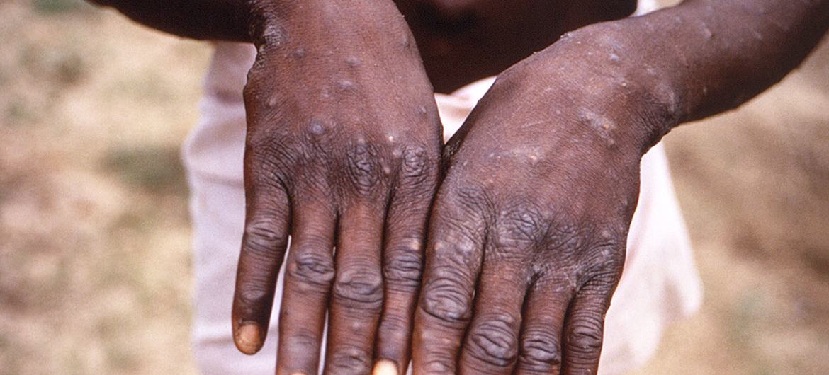 Statement – Investigations ongoing into atypical cases of monkeypox now reported in eight countries in Europe