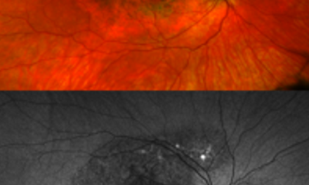 NIH researchers discover a new genetic eye disease