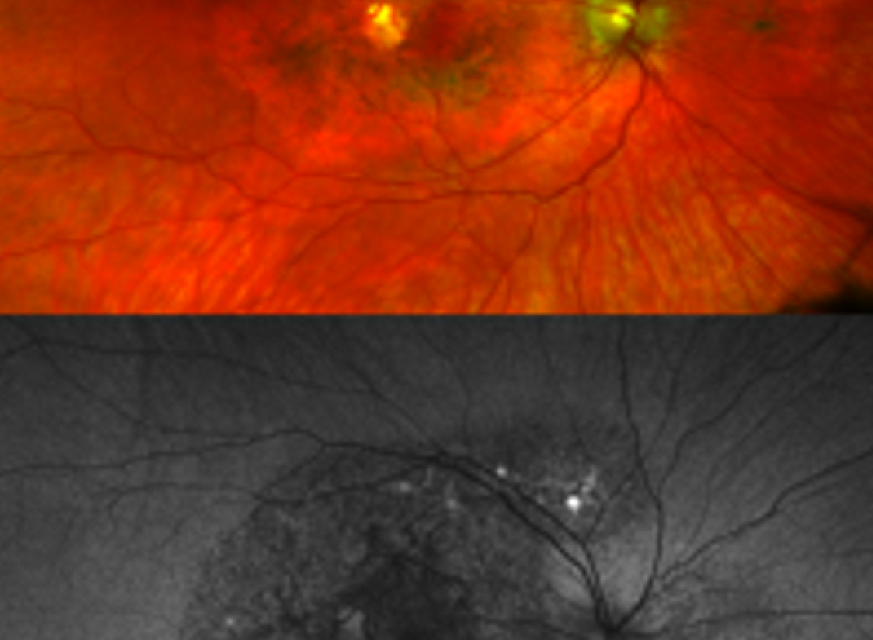 NIH researchers discover a new genetic eye disease