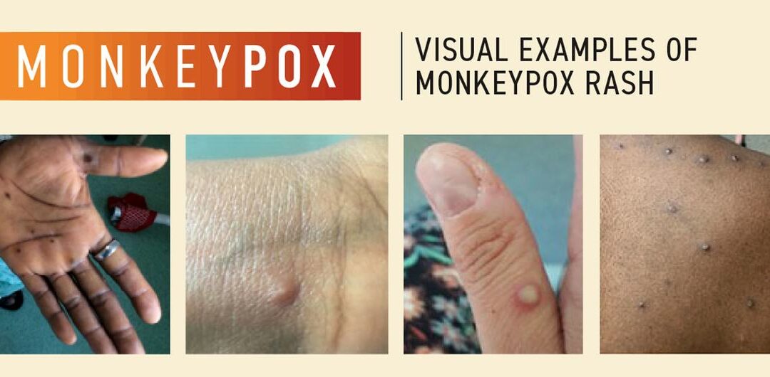 Top NIH Scientists Charged with Smuggling Mpox Vials from Congo Into U.S.