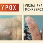 Mpox Surge in Pakistan Exposes Strain on Fragile Public Health System