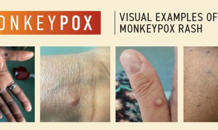 Monkeypox update: Delhi case