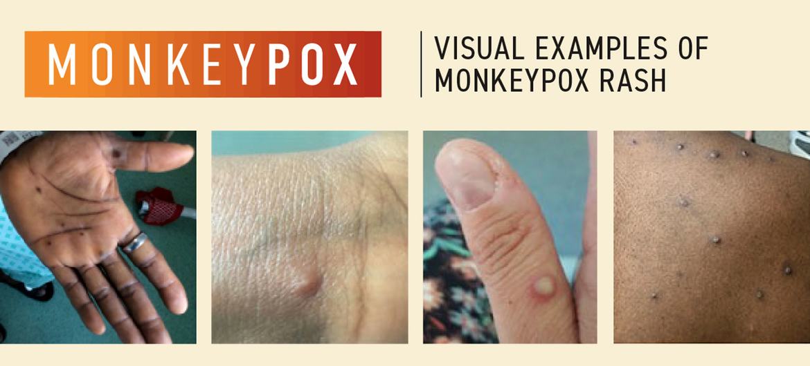 Monkeypox: How it spreads, who’s at risk – here’s what you need to know