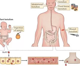 Iatrogenic Botulism- European Region