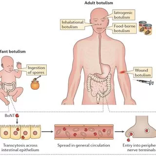 Iatrogenic Botulism- European Region