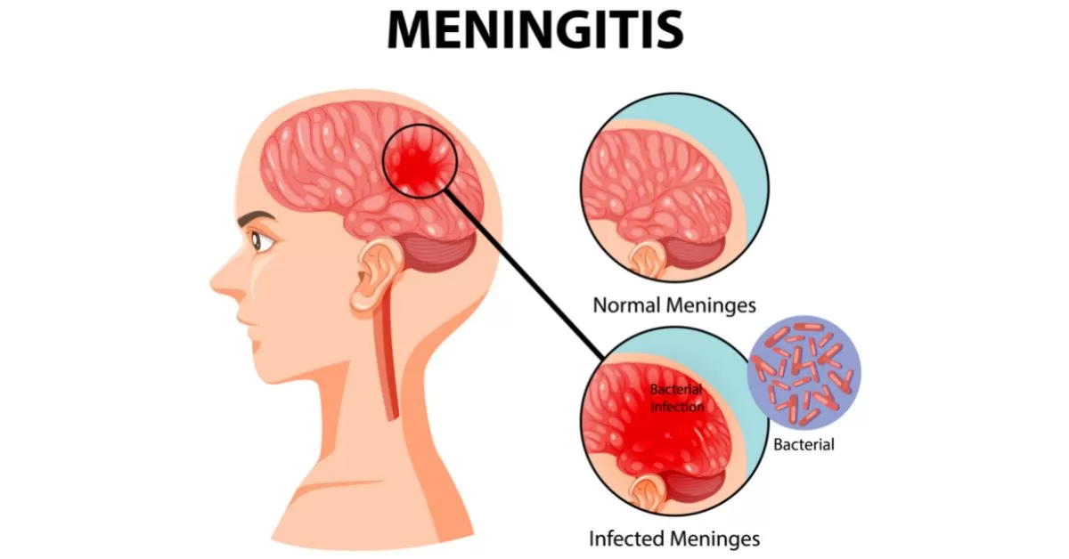 Pneumococcal meningitis – Togo