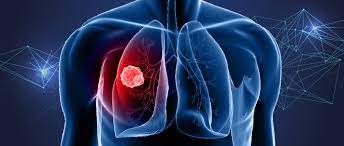 Increase in Lung Cancer Among Non-Smoking Women: What’s Behind the Rise?