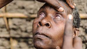 WHO congratulates Benin and Mali for eliminating trachoma as a public health problem