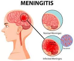 Devastating Impact: One in Three Children with Bacterial Meningitis Suffer Permanent Neurological Disabilities