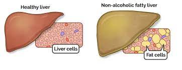 Study Reveals Poor Sleep May Worsen Fatty Liver Disease: Healthy Sleep Patterns Linked to Reduced Risk of Cirrhosis