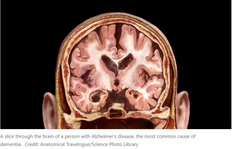 Dementia risk linked to blood-protein imbalance in middle age