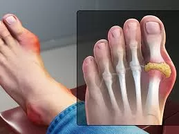 Gout: Suboptimal Management a Continuing Problem