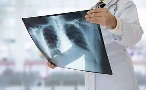 AI-Driven X-ray Machines Revolutionize Tuberculosis Detection in Uttar Pradesh