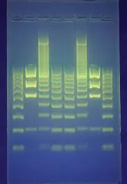 A single dose of the latest gene therapy has the potential to reduce ‘bad’ cholesterol by 50%