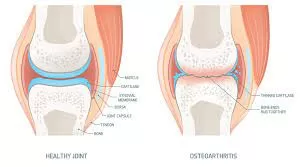 Addressing Osteoporosis: Strategies for Better Bone Health