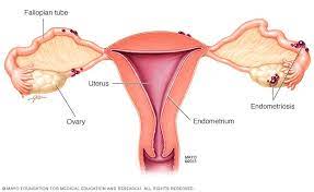 Endometriosis Linked to Increased Healthcare Utilization and Upper GI Symptoms: A Call for Comprehensive Diagnosis