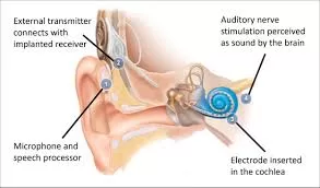 Study Challenges Traditional Approach: Sign Language Beneficial for Deaf Children with Cochlear Implants