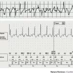 AI Outperforms Humans in Analyzing Long-Term ECG Recordings, Large International Study Finds