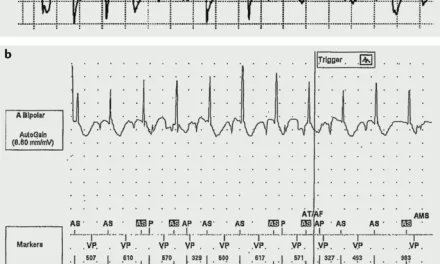 AI Model Can Read ECGs to Identify Female Patients at Higher Risk of Heart Disease