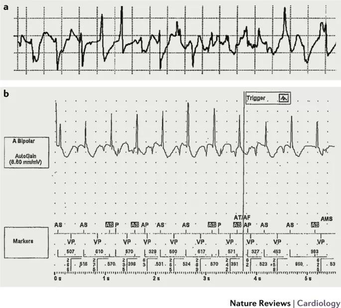 Research reveals that oral anticoagulation is ineffective for individuals experiencing atrial high-rate episodes