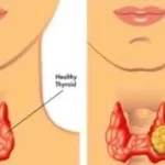 Study Links GLP-1 Receptor Agonists to Increased Thyroid Cancer Risk in First Year of Use