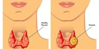 Thyroid Cancer Detections Rise Due to Increased Screenings Linked to GLP-1 Medications