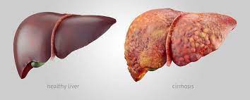 Breaking Ground: Targeted Metabolic Therapy Shows Promise in Preventing Liver Cancer