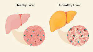 Research uncovers the reduction of liver triglycerides in individuals with fatty liver disease through increased intake of resistant starch