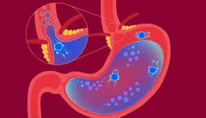 Addressing uncontrollable snoring can potentially alleviate nighttime respiratory and heartburn symptoms