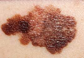 Breakthrough Study Reveals Insights into Melanoma Drug Resistance Mechanisms