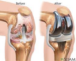 “Study Reveals Common Blood Pressure Medications Associated with Reduced Risk of Knee Replacement”