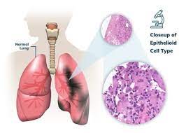 Study Shows Exhaled Breath Analysis Can Identify Malignant Pleural Mesothelioma