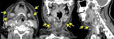 A CT test replicates blood flow to evaluate individuals at risk of angina