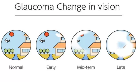 “Glaucoma: An Emerging Menace to Vision Health on the Horizon”