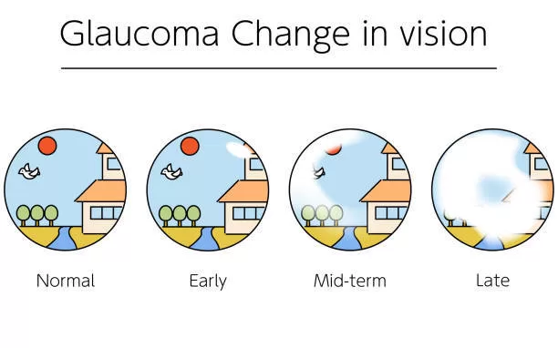 “Glaucoma: An Emerging Menace to Vision Health on the Horizon”