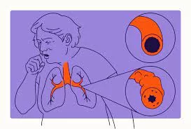 Suspected Bronchiectasis Linked to Increased Risk for Death in Smokers With Normal Lung Function and COPD