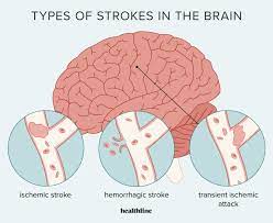 A study suggests that by the year 2050, strokes could result in approximately 10 million deaths each year