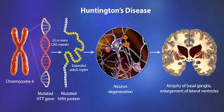 Research provides further insight into early interventions for Huntington’s disease