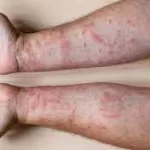 New Study Explains Why You Shouldn’t Scratch an Itchy Rash